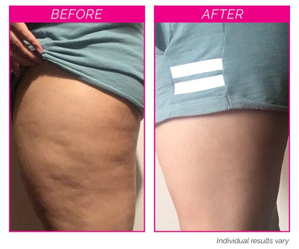 byebyecellulite-beforeafter Bye Bye Cellulite Kit before and after