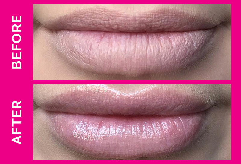 lip plumper befor after