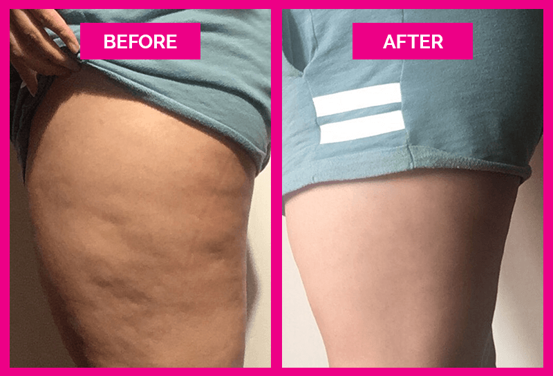 cellulite cupping before after