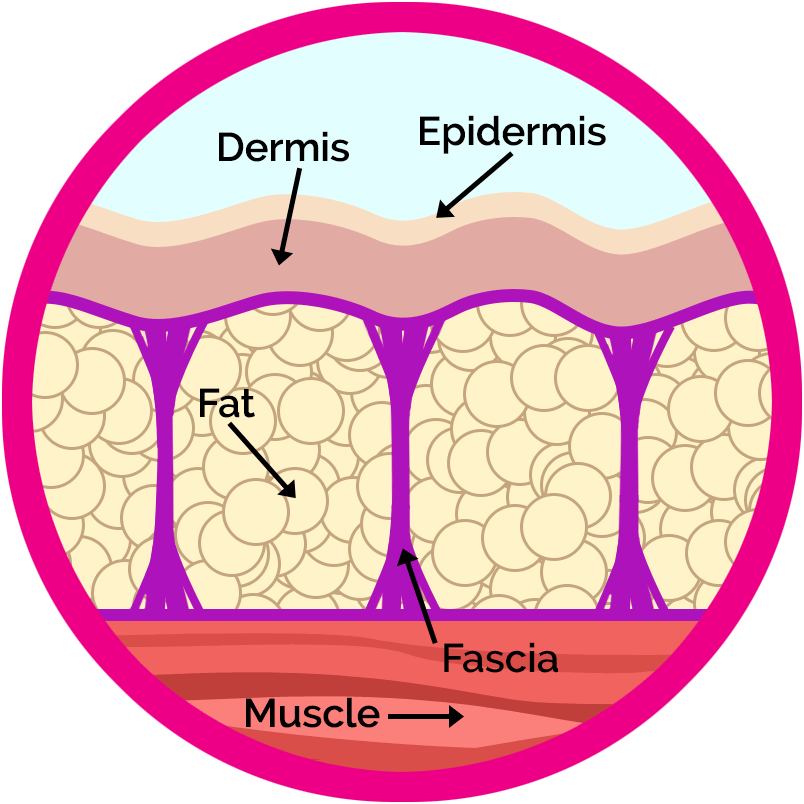 Cellulite