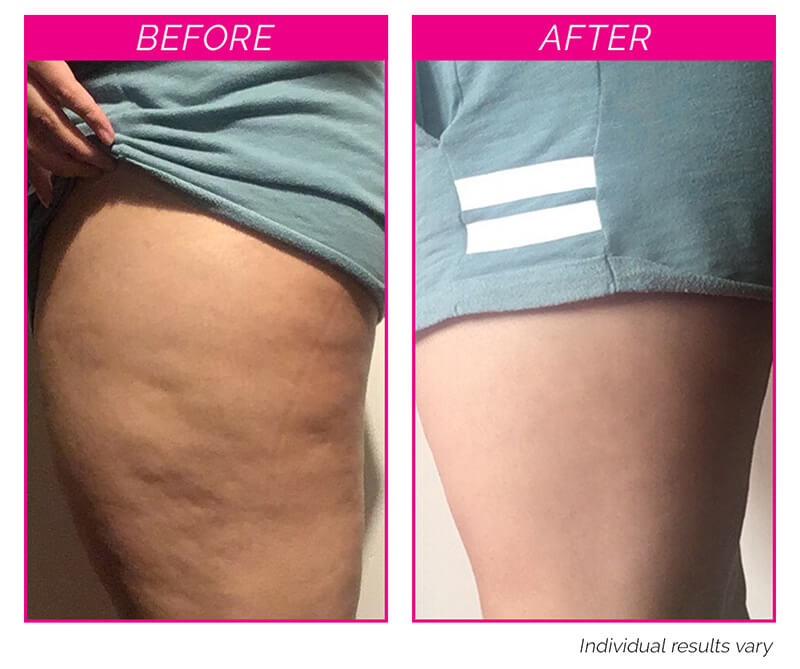 Bye Bye Cellulite Kit before and after