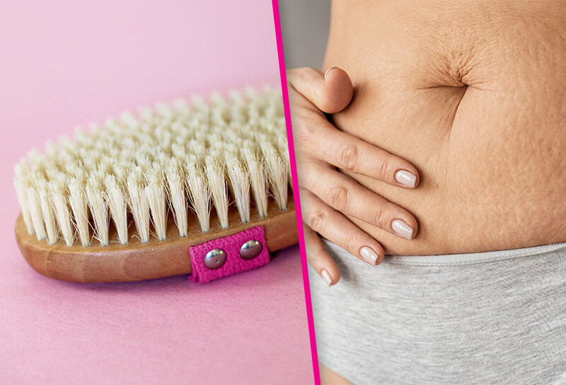 dry brushing stretch marks