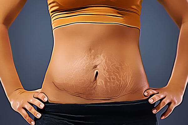 tummy with stretchmarks
