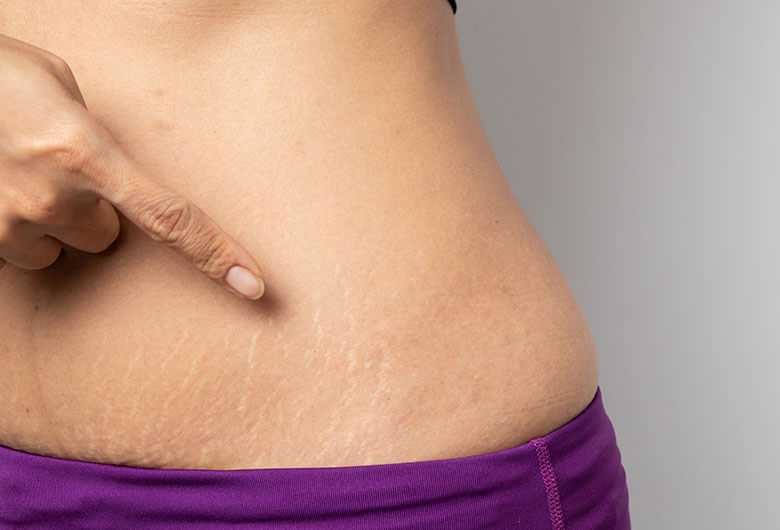 The Definitive Guide To Dry Brushing For Stretch Marks