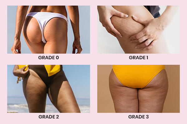 cellulite grades diagram