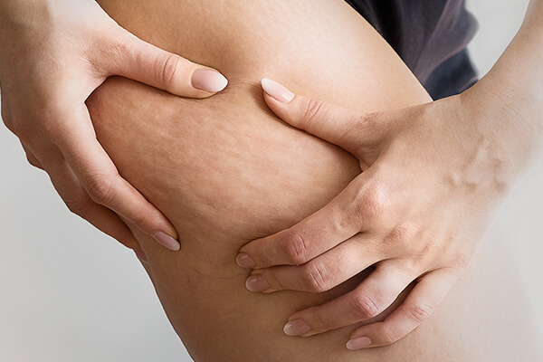 woman with leg cellulite