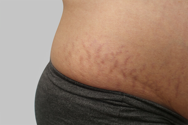 stretch marks on hips
