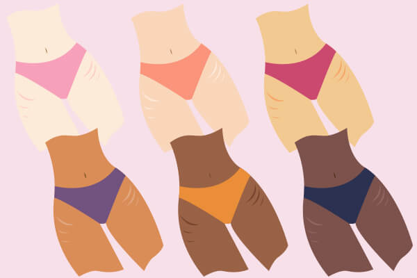 stretch marks diagram