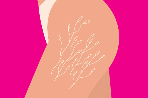 stretch marks on hips